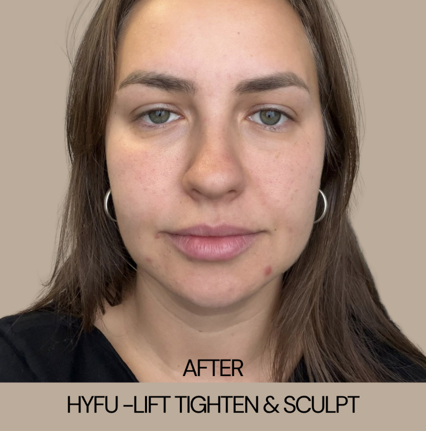 HYFU treatment after result - natural lifting and skin tightening