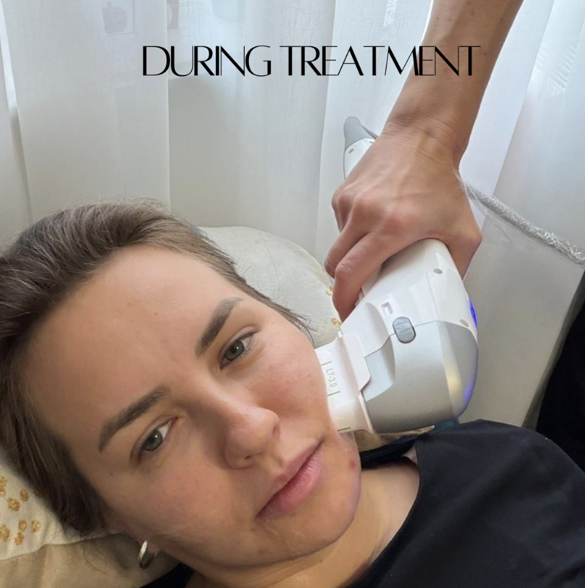HYFU non-surgical face lifting treatment in progress at Nurse Vella clinic